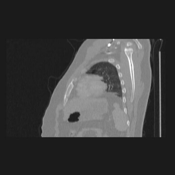 File:Bronchial atresia (Radiopaedia 60685-68439 Sagittal lung window 76).jpg