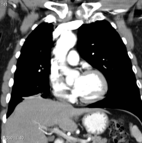File:Bronchial carcinoid tumor with right lower lobe collapse (Radiopaedia 29060-29422 C 10).jpg