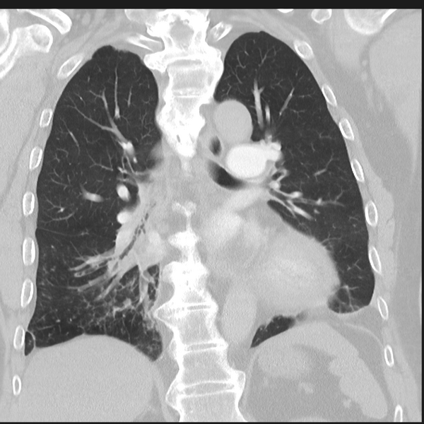 File:Bronchiectasis (Radiopaedia 39385-41666 Coronal lung window 19).png