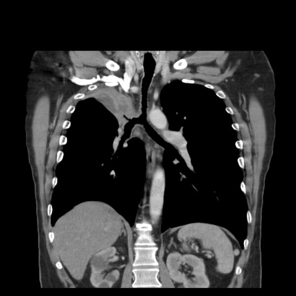 File:Bronchogenic carcinoma with upper lobe collapse (Radiopaedia 29297-29726 D 34).jpg