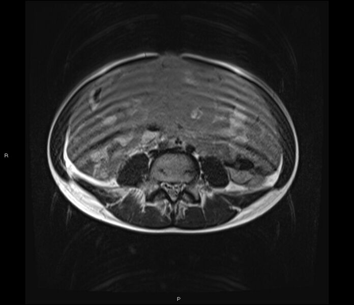 File:Burkitt lymphoma (bowel) (Radiopaedia 68839-78557 Axial T2 40).jpg