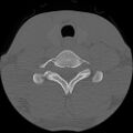 C5 facet fracture (Radiopaedia 58374-65499 Axial bone window 73).jpg