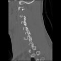 C5 facet fracture (Radiopaedia 58374-65499 Sagittal bone window 25).jpg