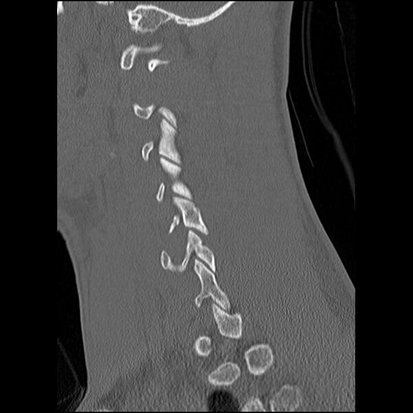 File:C5 facet fracture (Radiopaedia 58374-65499 Sagittal bone window 25).jpg