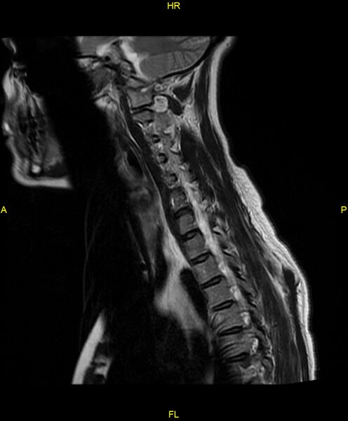 File:C5 nerve sheath tumor (Radiopaedia 85777-101596 Sagittal T2 8).jpg