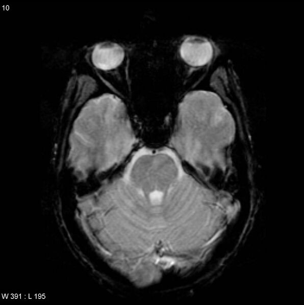 File:CMV ventriculitis and encephalitis (Radiopaedia 5416-7166 Axial Gradient Echo 2).jpg