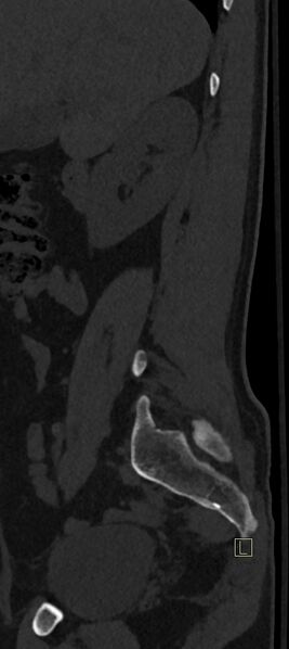 File:Calcaneal fractures with associated L2 burst fracture (Radiopaedia 71671-82493 Sagittal bone window 74).jpg