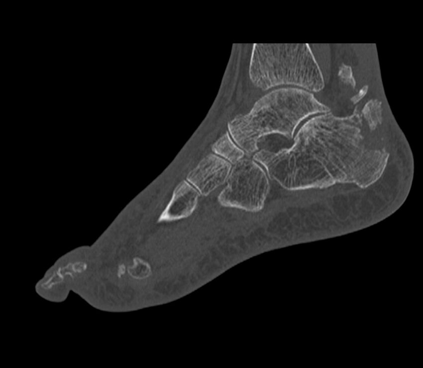 Calcaneal tuberosity avulsion fracture (Radiopaedia 22649-22668 Sagittal bone window 21).jpg