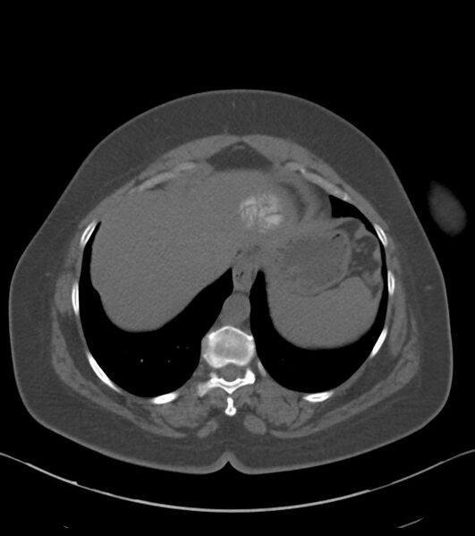 File:Calcified hepatic hydatid cyst (Radiopaedia 81127-94738 Axial non-contrast 13).jpg