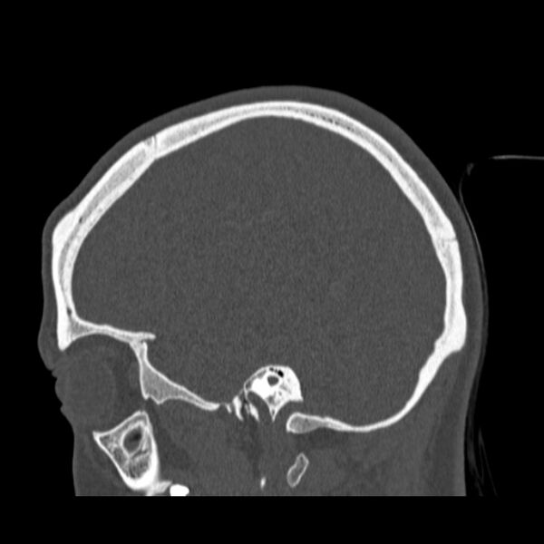 File:Calvarial osteoma (Radiopaedia 36520-38079 Sagittal bone window 35).jpg