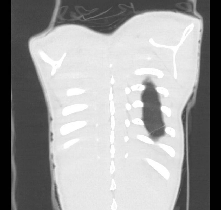 Cannabis-induced diffuse alveolar hemorrhage (Radiopaedia 89834-106946 Coronal lung window 4).jpg