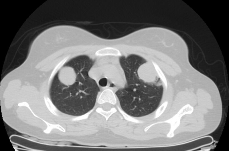 File:Cannonball metastases - uterine choriocarcinoma (Radiopaedia 70137-80173 Axial lung window 11).jpg