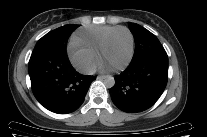 File:Cannonball metastases - uterine choriocarcinoma (Radiopaedia 70137-80173 Axial non-contrast 81).jpg