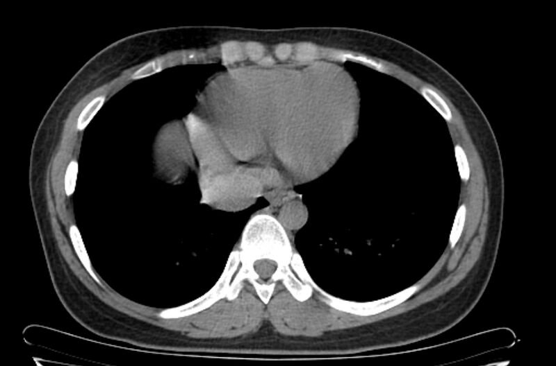 File:Cannonball metastases - uterine choriocarcinoma (Radiopaedia 70137-80173 Axial non-contrast 91).jpg