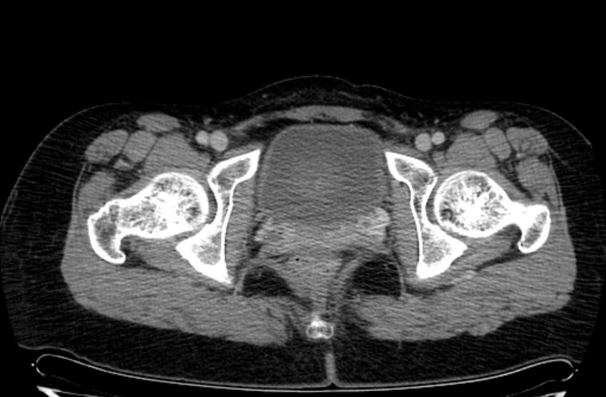 Cannonball metastases - uterine choriocarcinoma (Radiopaedia 70137-80174 A 53).jpg