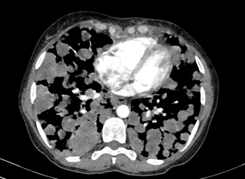 File:Cannonball metastases from breast cancer (Radiopaedia 91024-108569 A 81).jpg