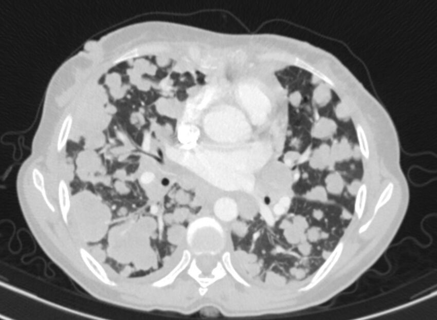Cannonball metastases from breast cancer (Radiopaedia 91024-108569 Axial lung window 52).jpg