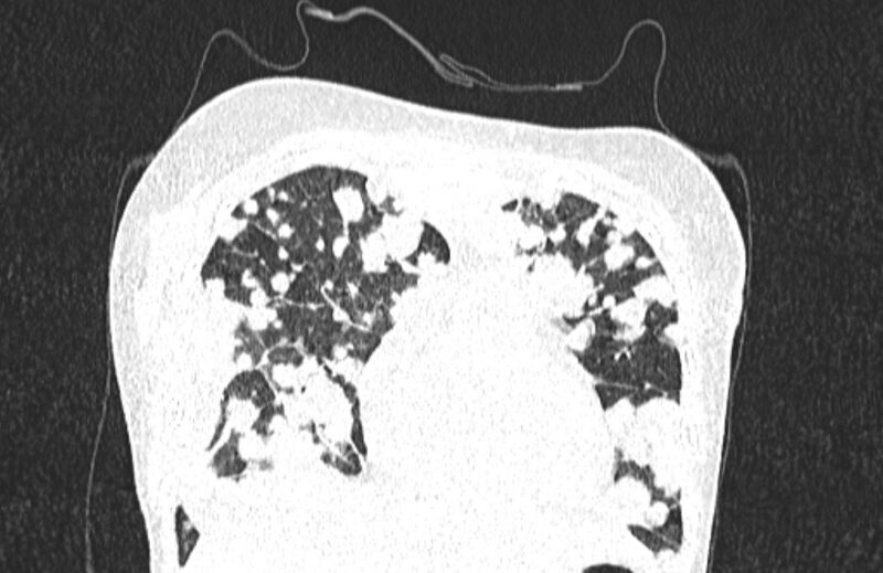 File:Cannonball metastases from breast cancer (Radiopaedia 91024-108569 Coronal lung window 34).jpg