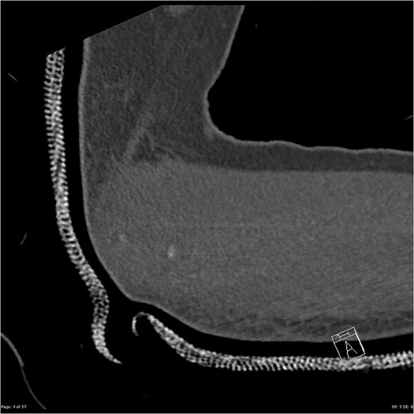 File:Capitellum fracture (Radiopaedia 23352-23426 Sagittal bone window 4).jpg