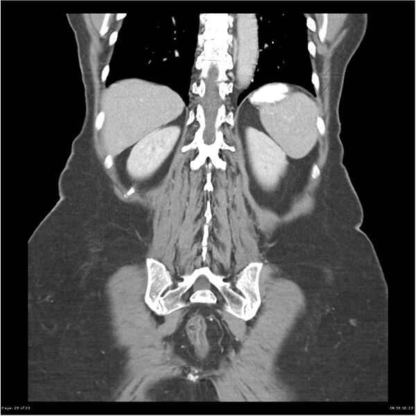 File:Carcinoid tumor of the ileum with metastasis to orbit (Radiopaedia 28165-28425 B 28).jpg