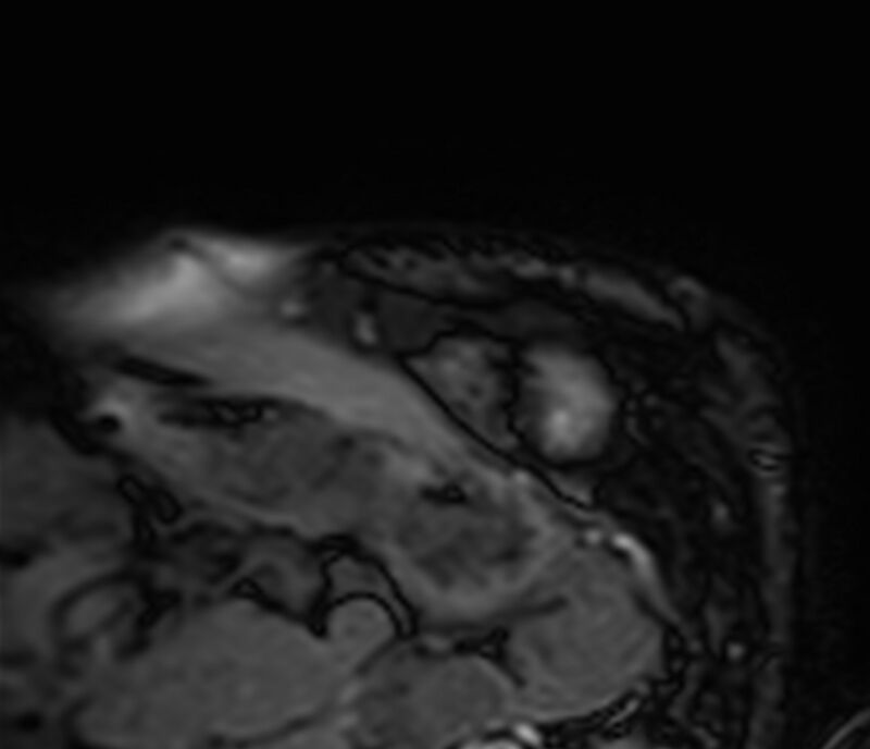 Cardiac amyloidosis (Radiopaedia 39736-42124 F 16).jpg