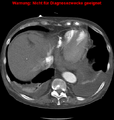 Cardiac perforation following transcatheter aortic valve implantation (Radiopaedia 23714-23863 A 15).png