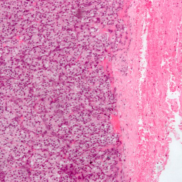 File:Carotid body tumor (histology) (Radiopaedia 7681-8498 H&E 1).jpg