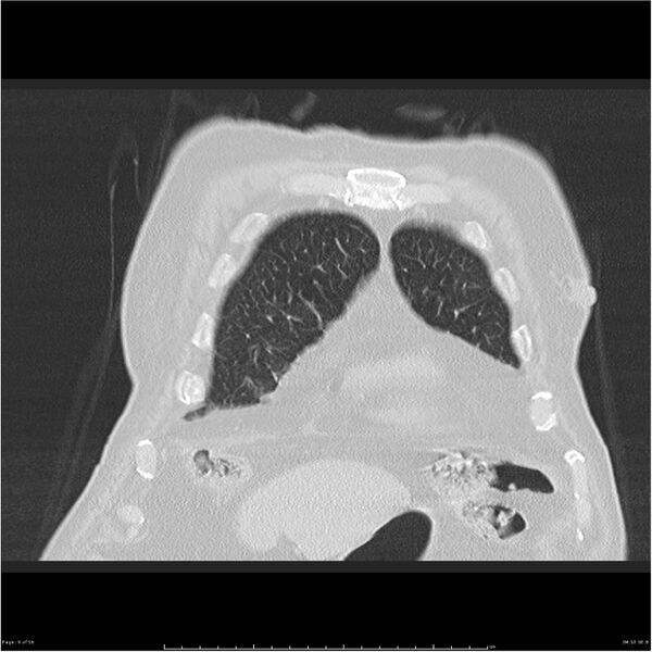 File:Cavitating left lower lobe lesion - squamous cell lung cancer (Radiopaedia 27749-28176 Coronal lung window 9).jpg