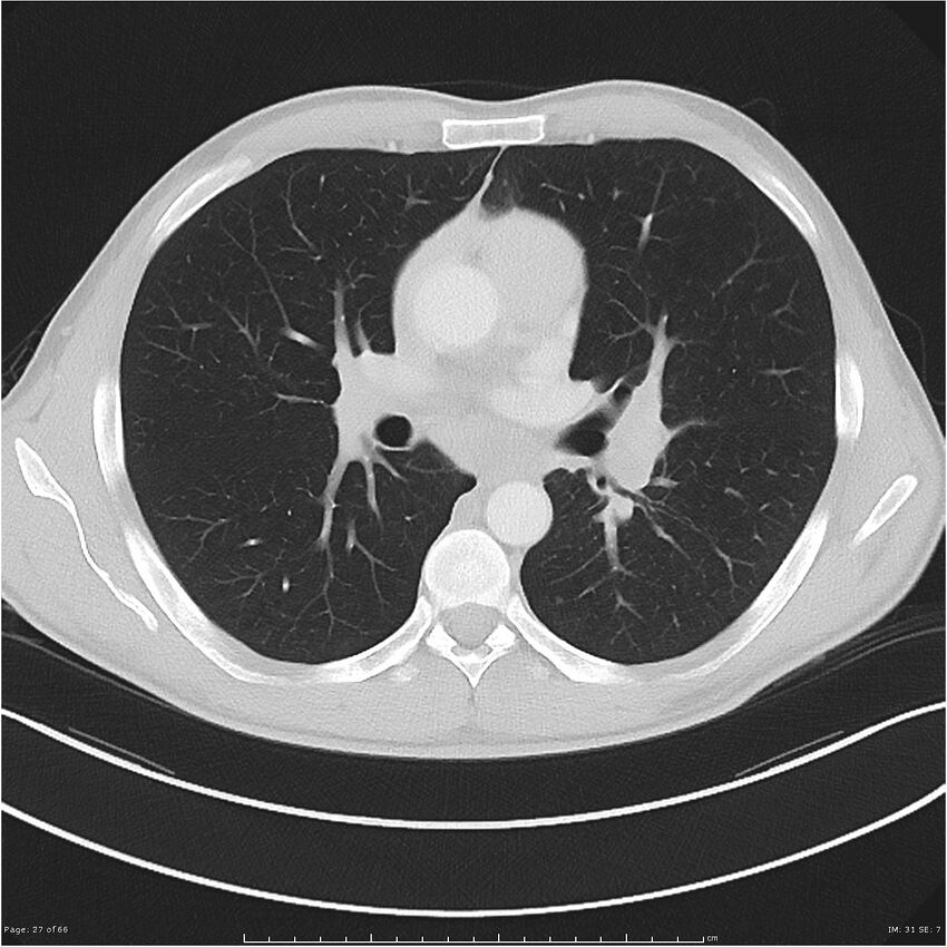 Cavitating lung cancer (Radiopaedia 25796-25945 Axial lung window 27).jpg