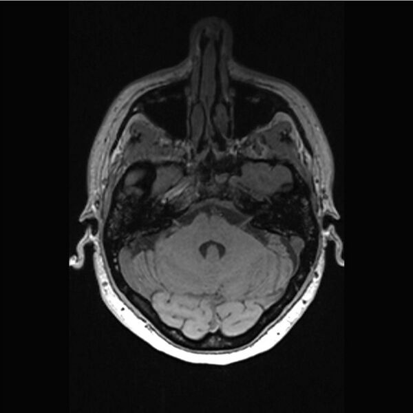 File:Central base of skull meningioma (Radiopaedia 53531-59549 Axial T1 3).jpg