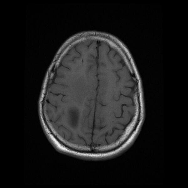 File:Central neurocytoma (Radiopaedia 67618-77021 Axial T1 20).jpg