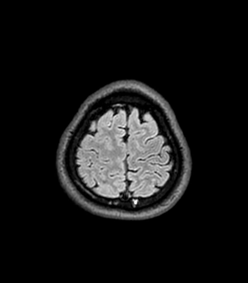 Central neurocytoma (Radiopaedia 79320-92380 Axial FLAIR 56).jpg
