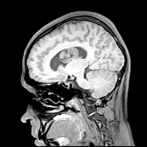 File:Central neurocytoma (Radiopaedia 79320-92380 Sagittal T1 111).jpg