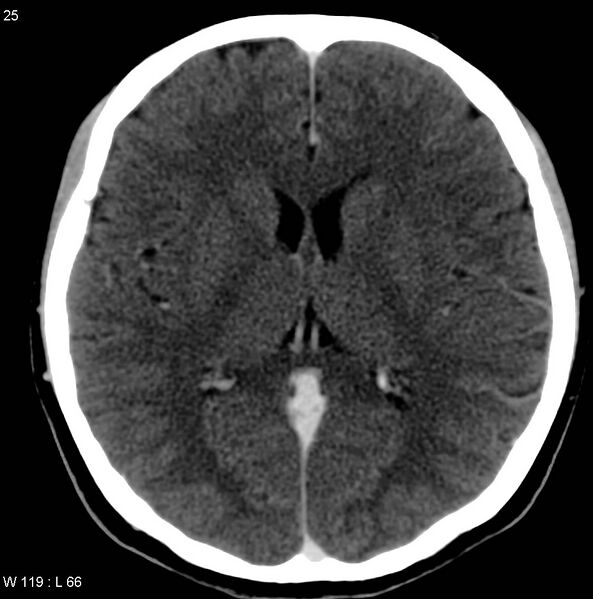 File:Cerebellar arteriovenous malformation (Radiopaedia 5220-36607 A 12).jpg
