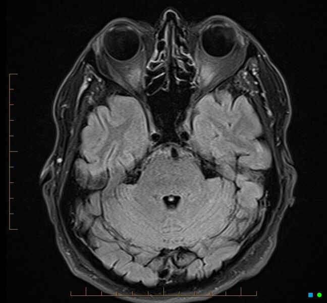 File:Cerebellar gangliocytoma (Radiopaedia 65377-74422 Axial FLAIR 11).jpg