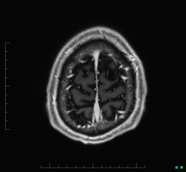 File:Cerebellar gangliocytoma (Radiopaedia 65377-74422 Axial T1 C+ 132).jpg
