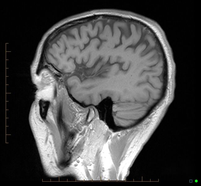 File:Cerebellar gangliocytoma (Radiopaedia 65377-74422 Sagittal T1 35).jpg
