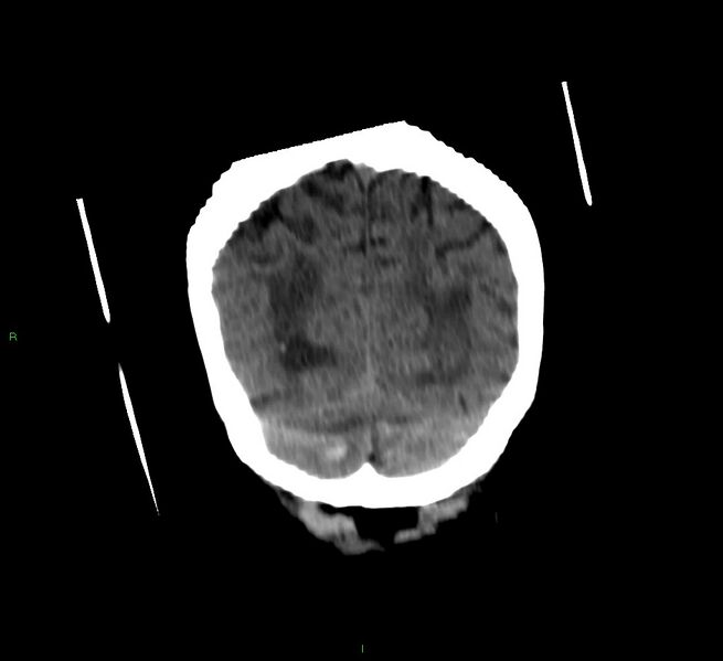 File:Cerebellar hemorrhage (Radiopaedia 58792-66026 Coronal non-contrast 16).jpg