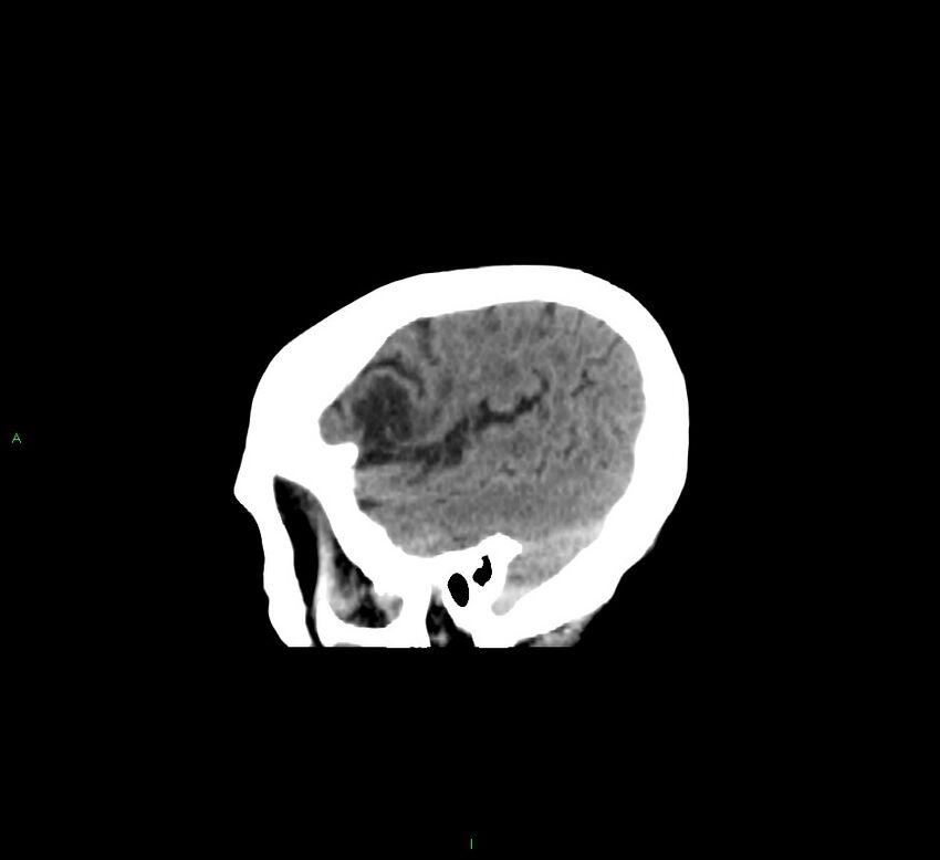 Cerebellar hemorrhage (Radiopaedia 58793-66027 C 11).jpg