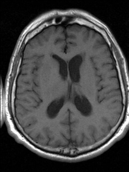 File:Cerebellopontine angle meningioma (Radiopaedia 24459-24764 Axial T1 14).jpg