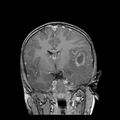 Cerebral abscess post cardiac surgery (Radiopaedia 27244-27420 Coronal T1 C+ 10).jpg