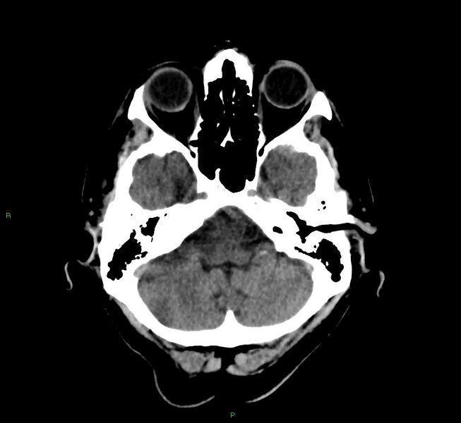 File:Cerebral amyloid angiopathy-associated lobar intracerebral hemorrhage (Radiopaedia 58376-65513 Axial non-contrast 41).jpg