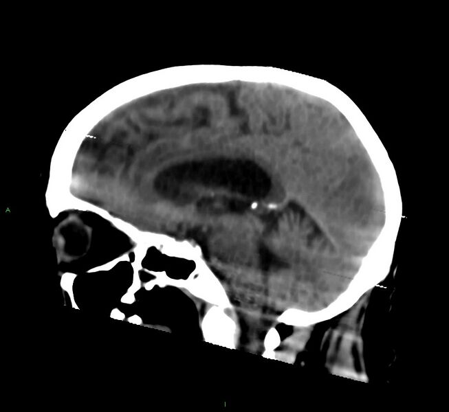 File:Cerebral amyloid angiopathy-associated lobar intracerebral hemorrhage (Radiopaedia 58377-65514 B 25).jpg
