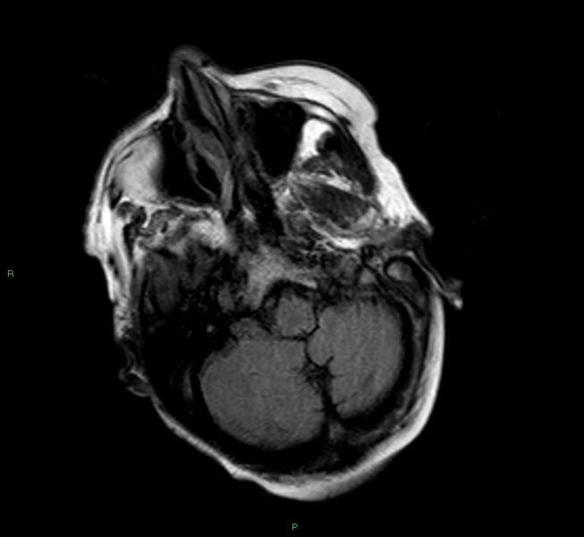 File:Cerebral amyloid angiopathy-associated lobar intracerebral hemorrhage (Radiopaedia 58377-65515 Axial FLAIR 22).jpg