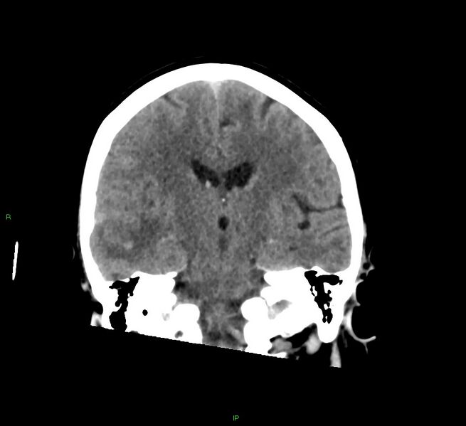 File:Cerebral amyloid angiopathy-associated lobar intracerebral hemorrhage (Radiopaedia 58378-65516 Coronal non-contrast 31).jpg