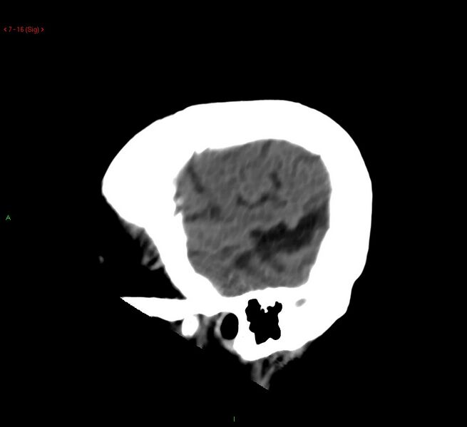 File:Cerebral amyloid angiopathy-associated lobar intracerebral hemorrhage (Radiopaedia 58378-65518 C 16).jpg
