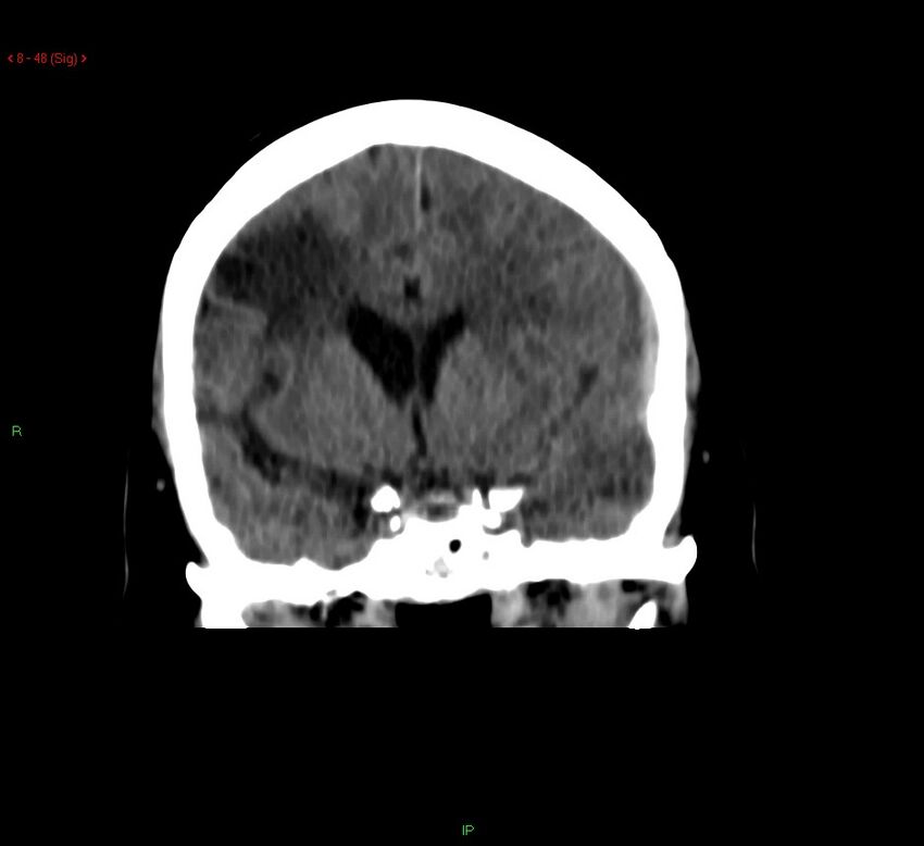 Cerebral amyloid angiopathy-associated lobar intracerebral hemorrhage (Radiopaedia 58378-65518 Coronal non-contrast 48).jpg