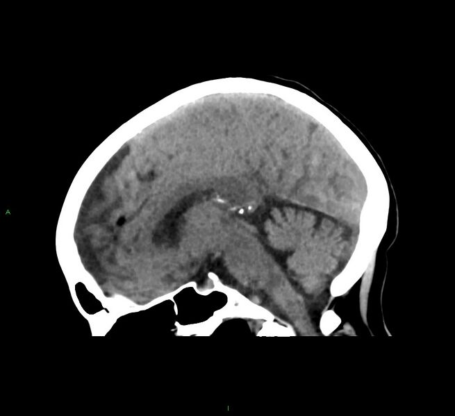 File:Cerebral amyloid angiopathy-associated lobar intracerebral hemorrhage (Radiopaedia 58563-65727 C 28).jpg