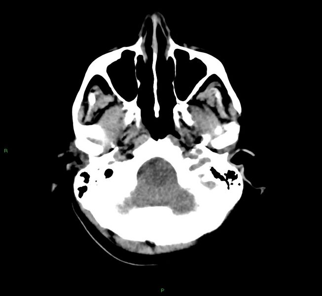 File:Cerebral amyloid angiopathy-associated lobar intracerebral hemorrhage (Radiopaedia 58566-65730 Axial non-contrast 44).jpg