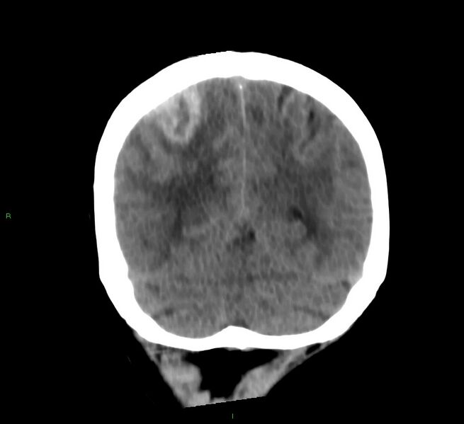 File:Cerebral amyloid angiopathy-associated lobar intracerebral hemorrhage (Radiopaedia 58566-65730 Coronal non-contrast 21).jpg
